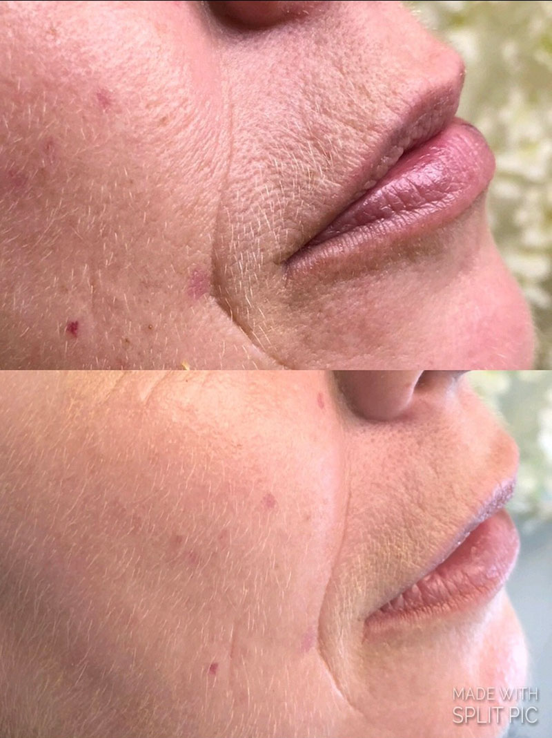 Microneedling_gallery2