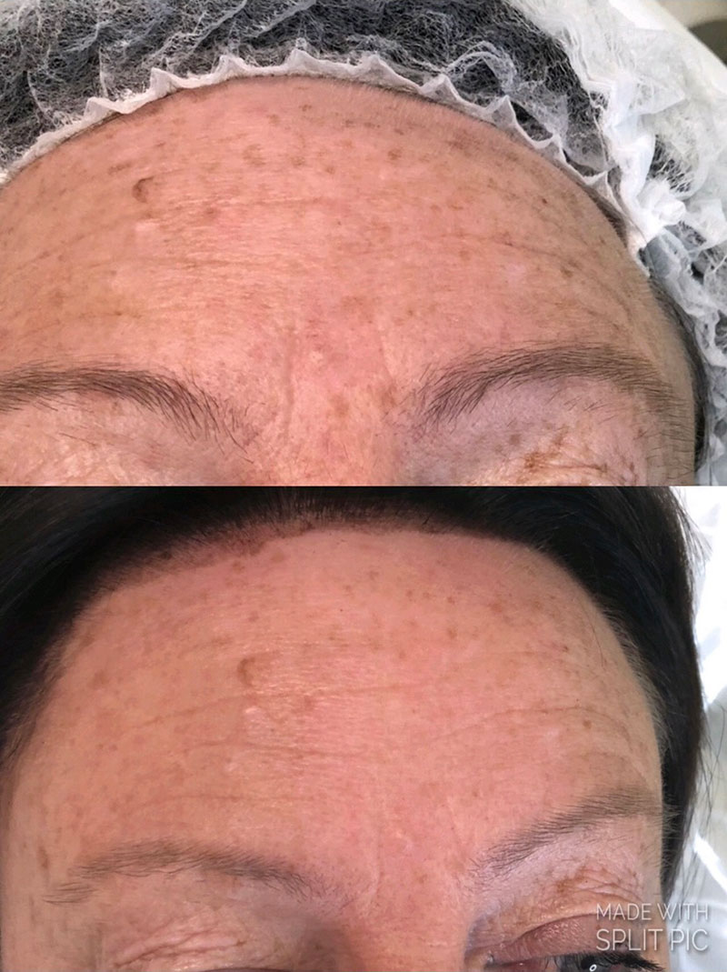 Microneedling_gallery3