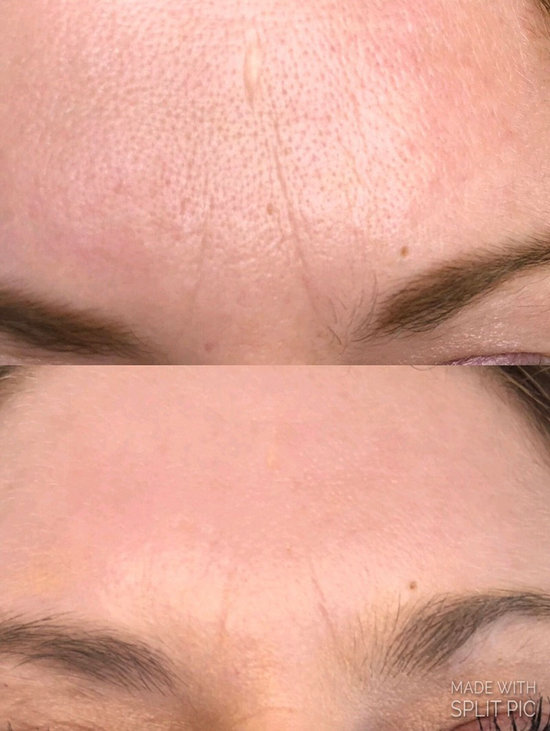 Microneedling_gallery4